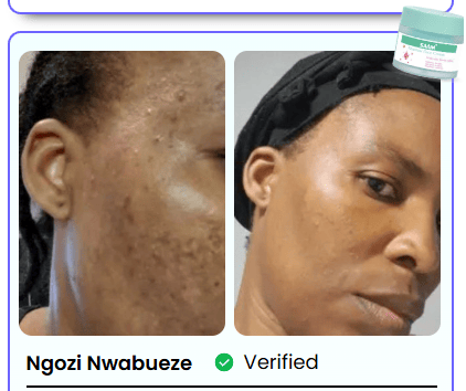 BONDABOU SHOP TACHES BRUNES, HYPERPIGMENTATION DU MÉLASMA ?